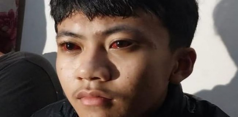 Viral, Efek Gas Air Mata Bikin Mata Merah Seminggu