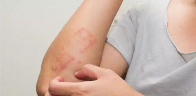 Ini Perbedaan Gejala DBD dan Covid-19